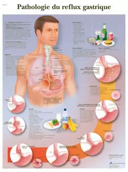 Anatomische Bord ; Pathologie   Magen-Reflux VR2711L