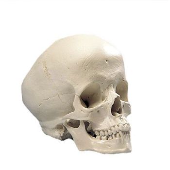 Hydrocephaler Schädel A29/2