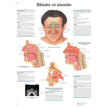 Anatomischen Bord : Rhinitis und Sinusitis VR2251L