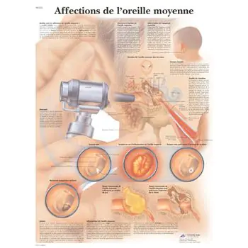 Anatomisches Bord : der Mittelohrerkrankungen VR2252UU