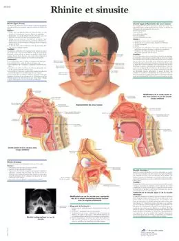 Anatomischen Bord : Rhinitis und Sinusitis VR2251L
