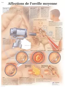 Anatomisches Bord : der Mittelohrerkrankungen VR2252UU